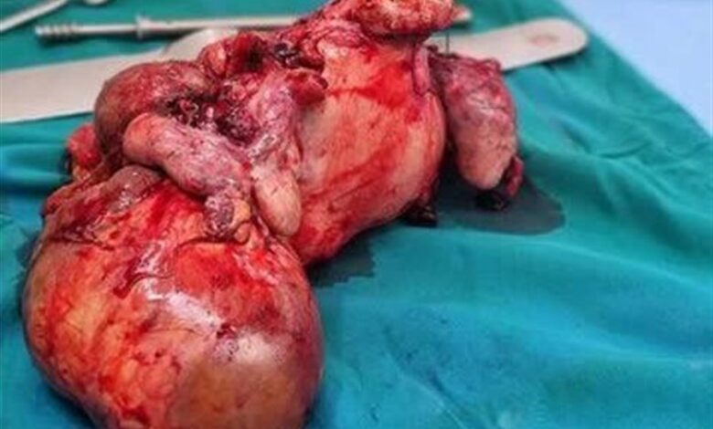 تومور 16 کیلویی از شکم بیمار ترکمنستانی در مشهد خارج شد