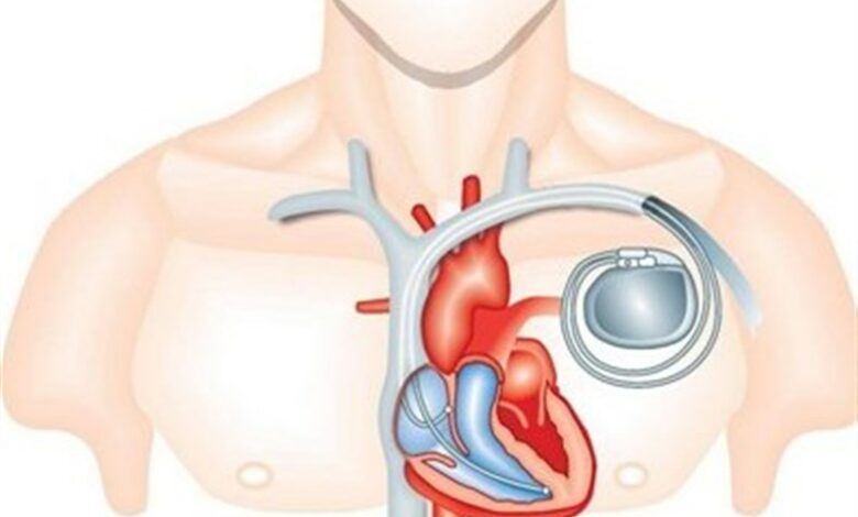 پیوند باتری قلب به روش نیمه‌تهاجمی در کرج
