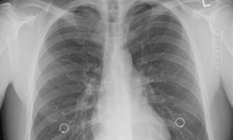 افزایش نگرانکننده سرطان ریه در گلستان/ تریاک خطر ابتلا را 3.6 برابر افزایش میدهد / اخبار گلستان - اخبار استانها